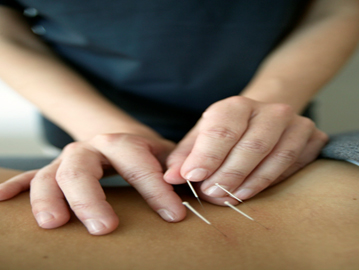 Acupuncture at St. Charles Pain & Wellness Center